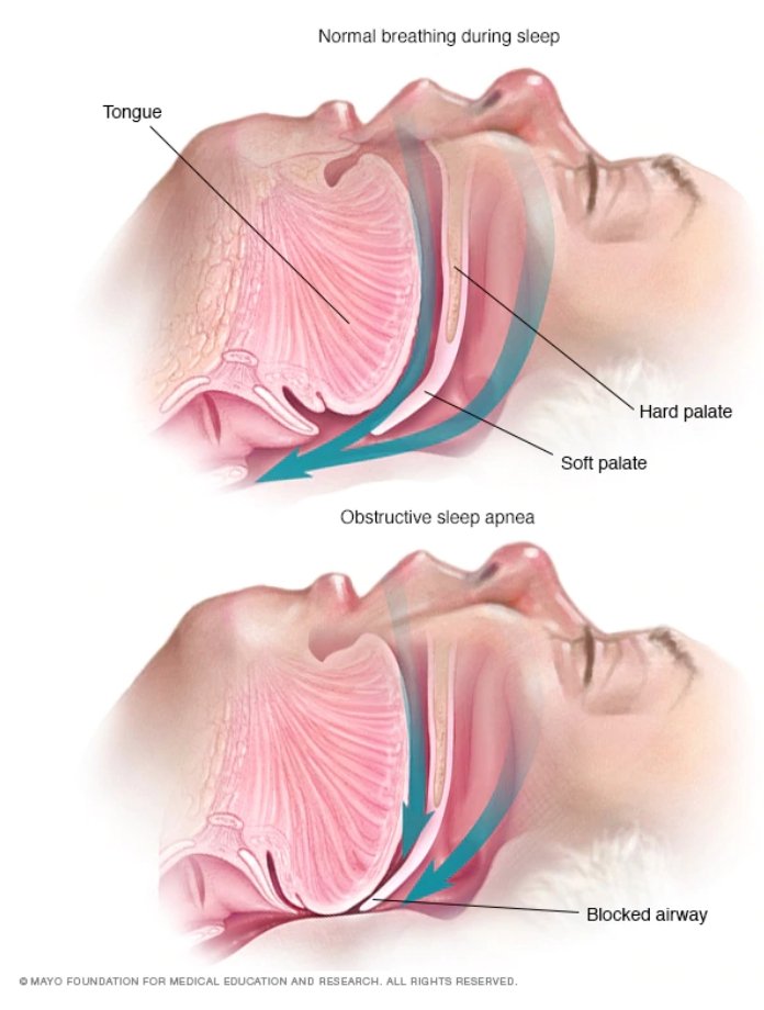 What is Sleep Apnea and Treatments | CPAP fix